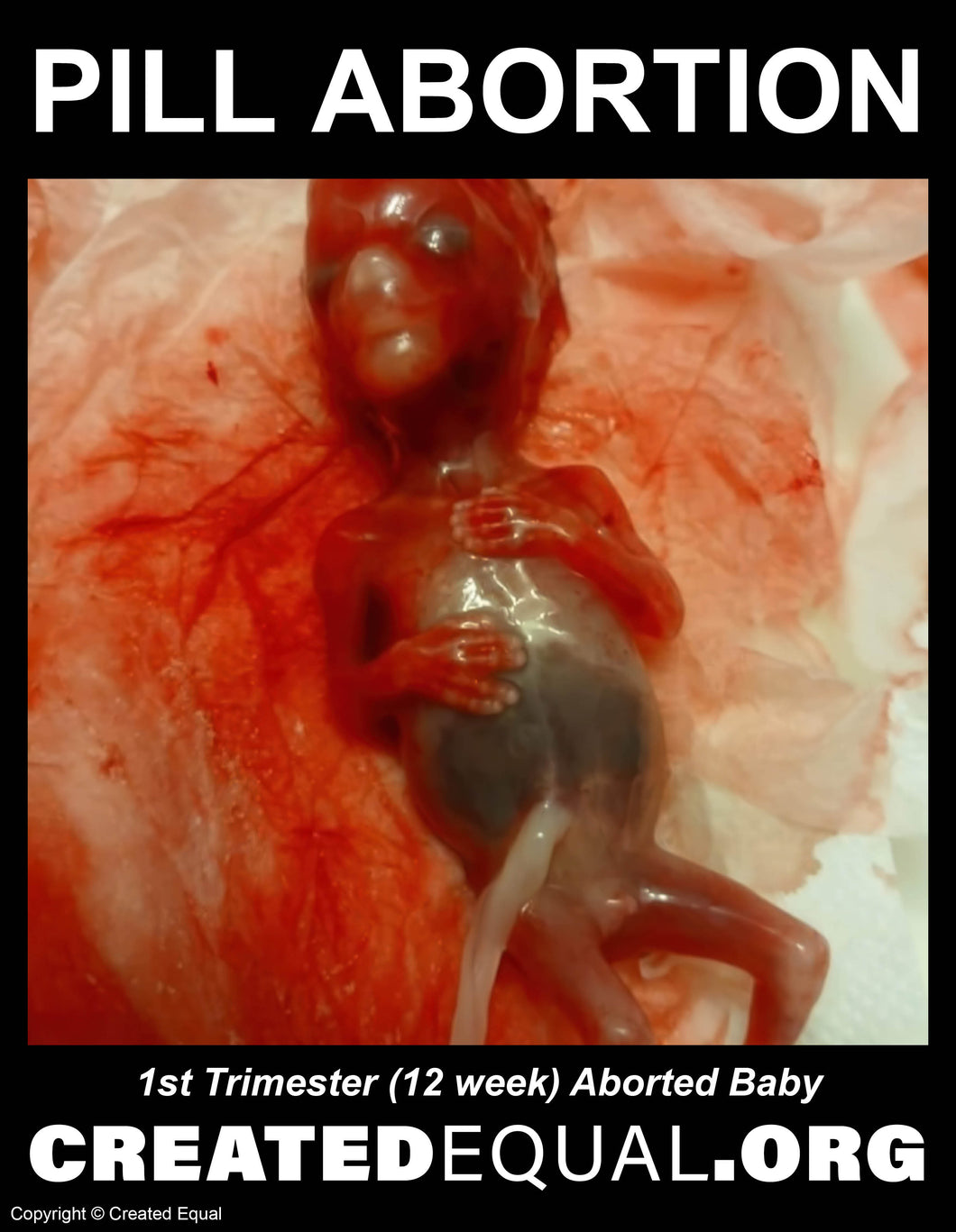 Pill Abortion Victim Sign