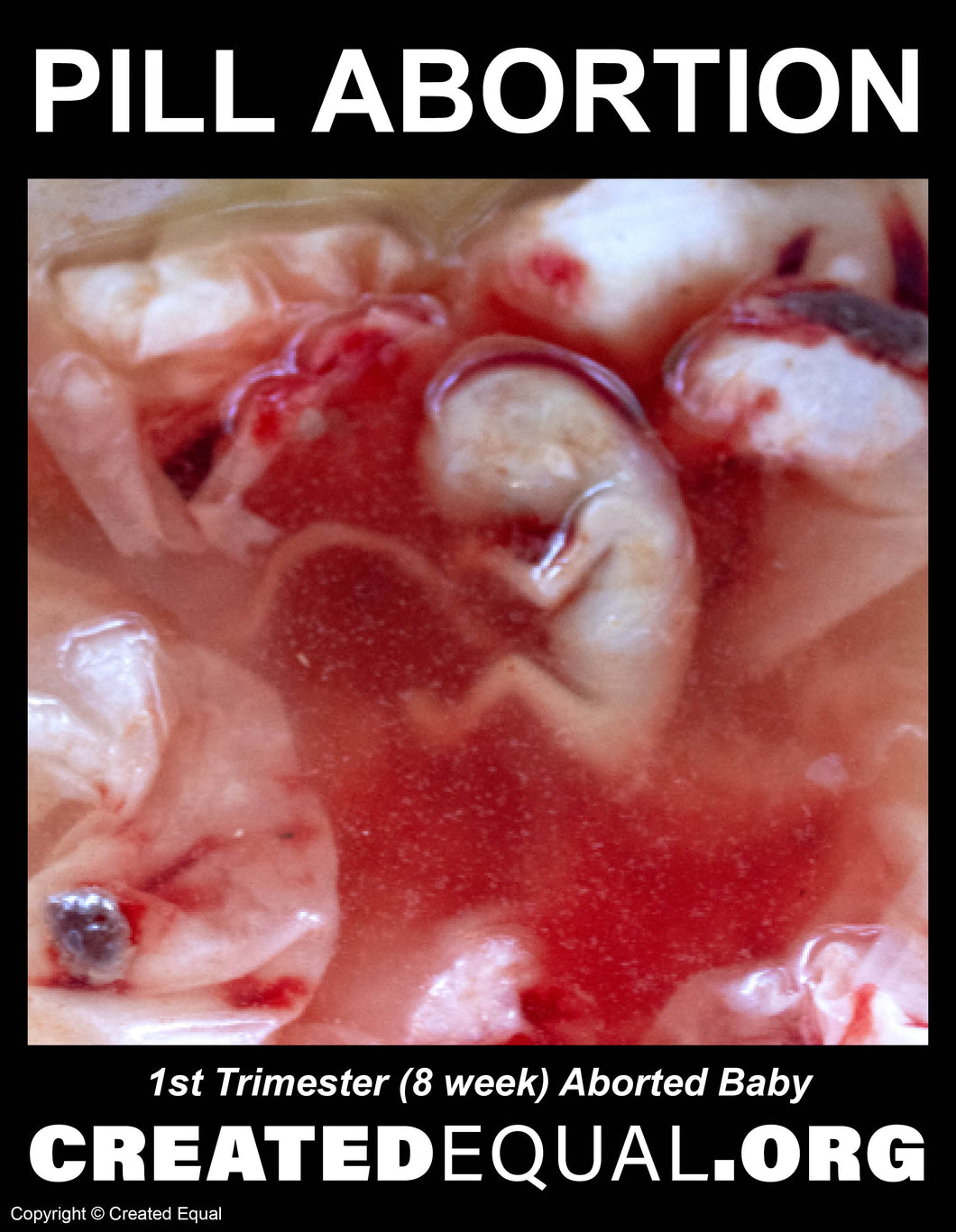 Pill Abortion Victim Sign