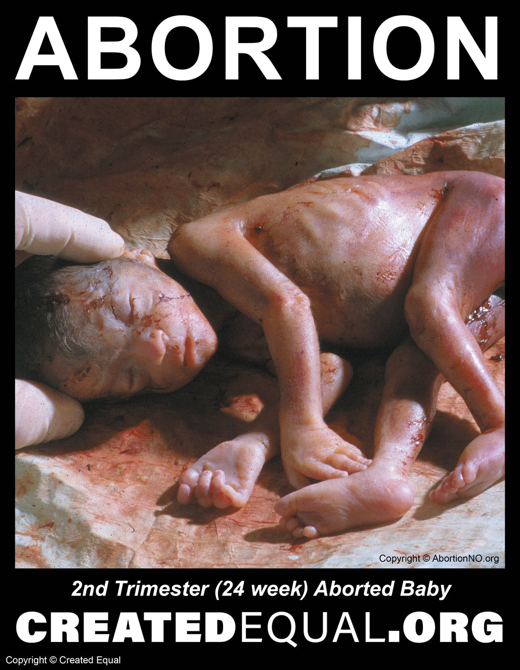 Abortion Victim Sign